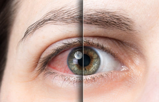 Conjunctivitis Decoded: Types, Symptoms, and Effective Management